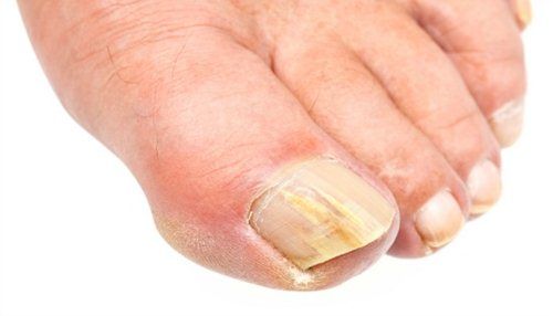 gomba által érintett körmök levágása nail funguff küzdelem