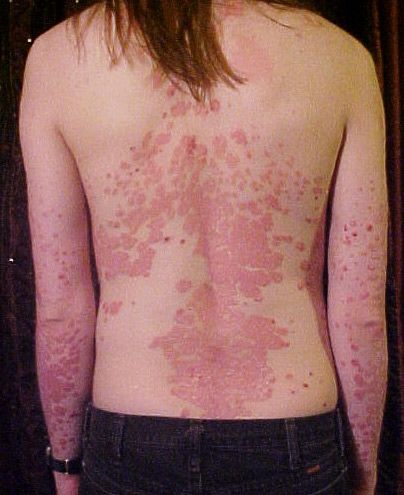 hogyan lehet pikkelysömör gyógyítani a karon a bőrt vörös foltok borítják, mint fürdés után